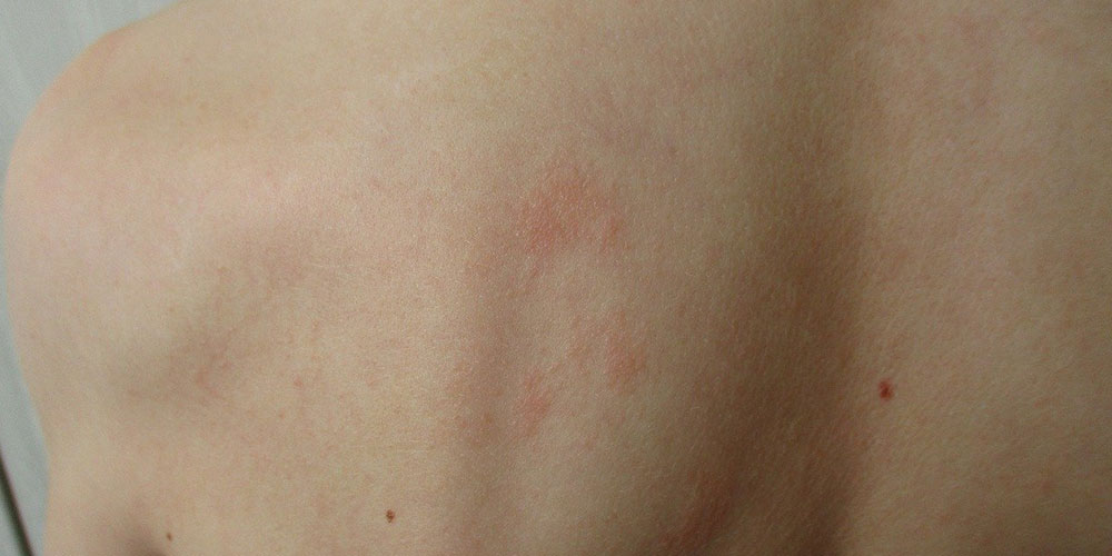 photo showing skin rashes